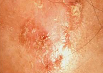 Pre-Cancerous Actinic Keratosis