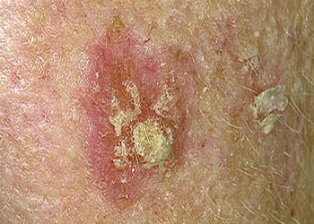 Pre-Cancerous Actinic Keratosis Pre-Cancerous Actinic Keratosis
