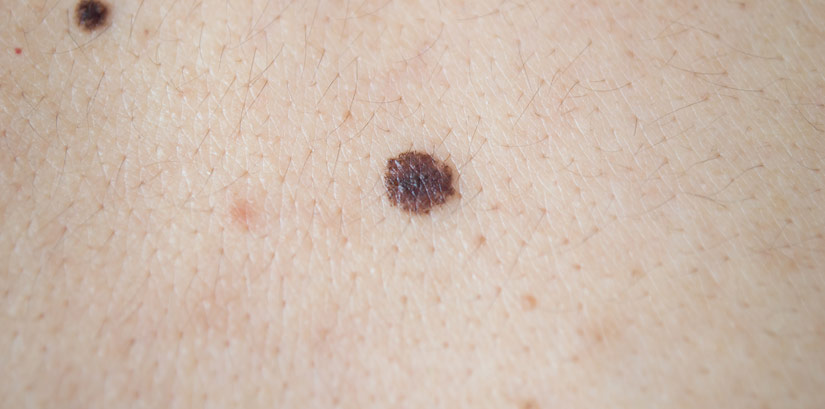 Lesions on a person's skin