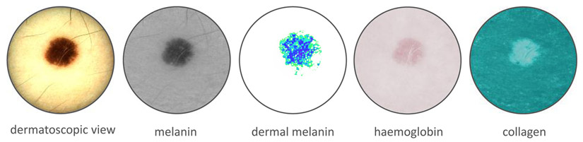 Scans of a mole using Spotscreen's SIAscope technology