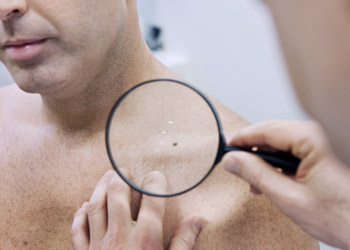 Man getting his suspicious mole checked by a Spotscreen screening practitioner