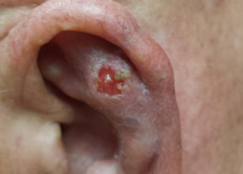 Skin Cancer - Basal Cell Carcinoma (BCC)