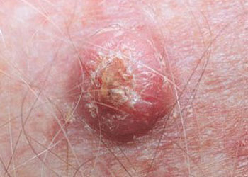 Skin Cancer - Squamous Cell Carcinoma (SCC) Skin Cancer - Squamous Cell Carcinoma (SCC)