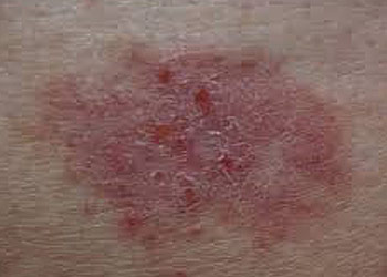 Skin Cancer - Basal Cell Carcinoma (BCC)