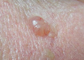 Skin Cancer - Basal Cell Carcinoma (BCC)