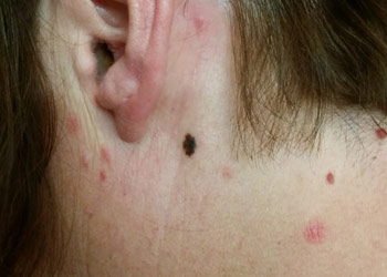 Skin Cancer - Melanoma Skin Cancer - Melanoma