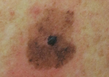 Skin Cancer - Melanoma