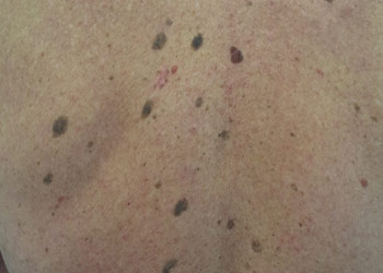 Skin Cancer - Melanoma